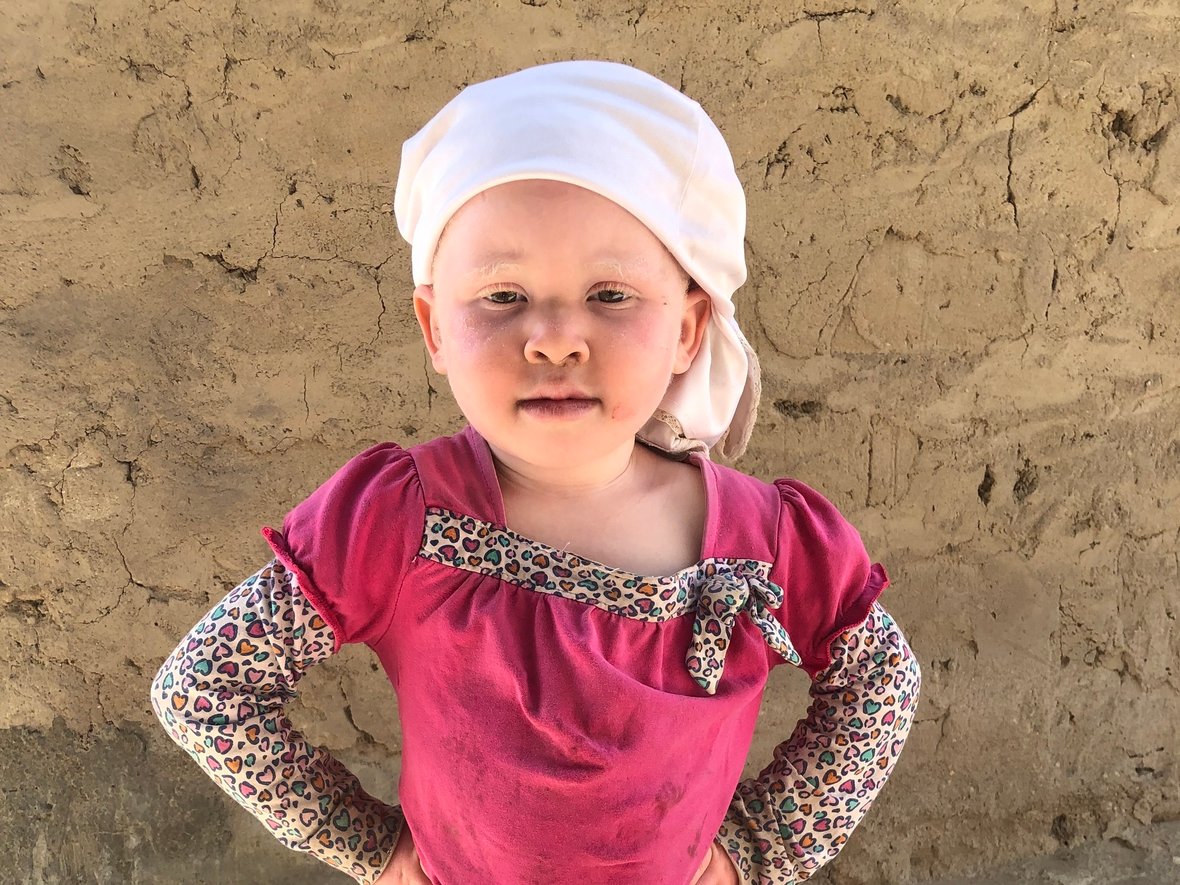 Dajmy Halimie i innym opuszczonym dzieciom z albinizmem nadzieję na lepsze jutro! - main photo