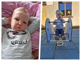 Konsultacje i operacja Frania oraz szansa dla innych poparzonych dzieci w Polsce