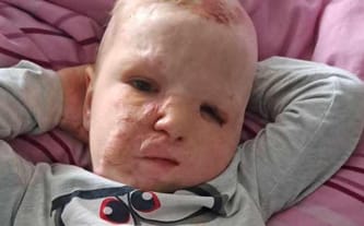 Konsultacje i operacja Frania oraz szansa dla innych poparzonych dzieci w Polsce