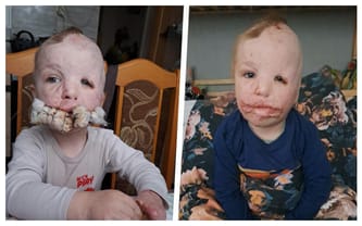 Konsultacje i operacja Frania oraz szansa dla innych poparzonych dzieci w Polsce