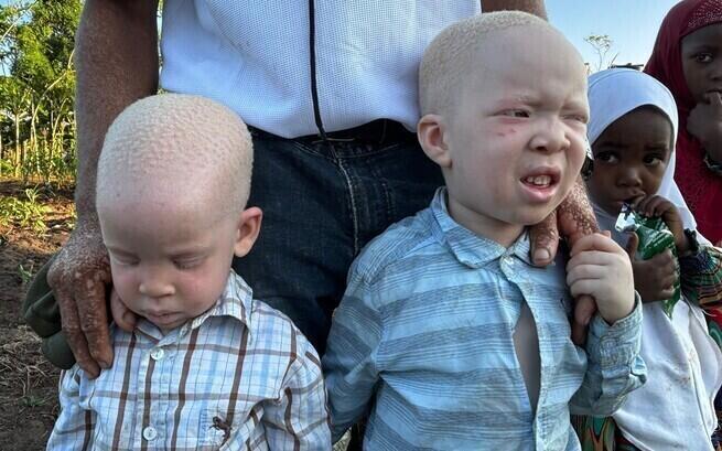 Dzieci z sierocińca chcą tylko w styczniu wrócić do szkoły! Pomóż im, bo albinizm w Tanzanii to zagrożenie dla życia. Fundacja ADRA Polska